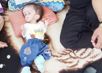 Kepala Membesar, Bayi Umur 10 Bulan Butuh Bantuan