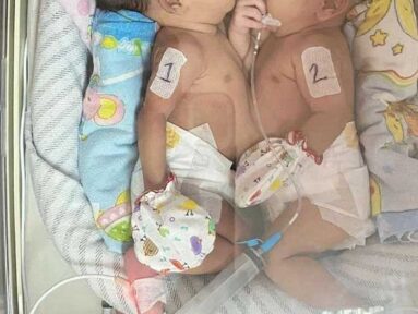 Kondisi Kesehatan Bayi Kembar Siam Cirebon Stabil, Dipantauan Tim Kesehatan Puskesmas hingga RS