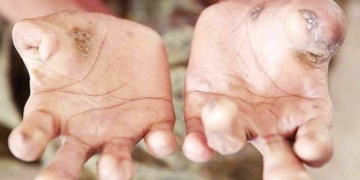 177 Warga di Kabupaten Cirebon Penderita Kusta, Bisa Sembuh, Dinkes Imbau Masyarakat Jangan Kucilkan