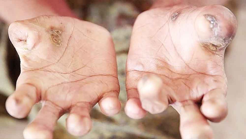 177 Warga di Kabupaten Cirebon Penderita Kusta, Bisa Sembuh, Dinkes Imbau Masyarakat Jangan Kucilkan