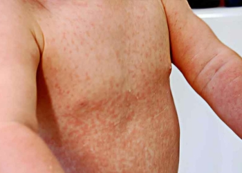 Penyebaran Kasus Campak-Rubella di Kabupaten Cirebon Merata, Wilayah Ini Terbanyak