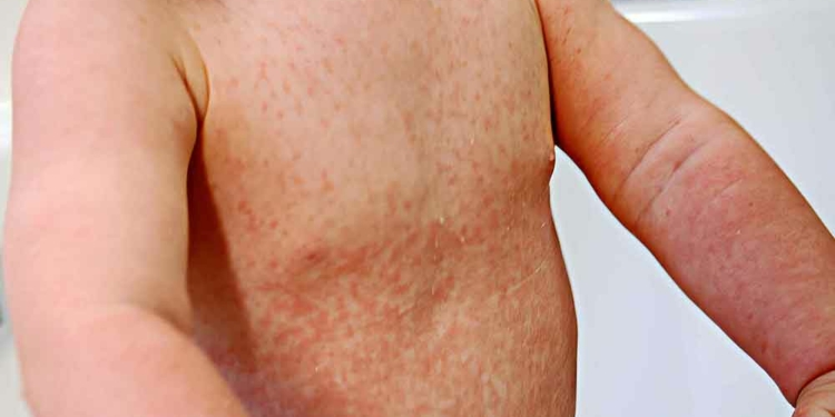 Penyebaran Kasus Campak-Rubella di Kabupaten Cirebon Merata, Wilayah Ini Terbanyak